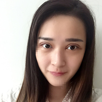 伊美馨做了開內(nèi)眼角和雙眼皮手術，分享我的術后果照片~~