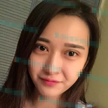 伊美馨做了開內(nèi)眼角和雙眼皮手術，分享我的術后果照片~~