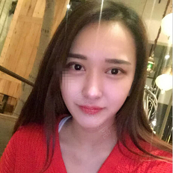 伊美馨做了開內(nèi)眼角和雙眼皮手術，分享我的術后果照片~~