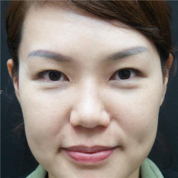李阿姨眼袋失敗修復(fù)手術(shù)后的果圖，年輕了好幾歲~