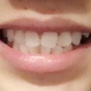 美容冠牙齒修復，緩解前后過程分享