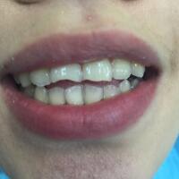 氧化鋯烤瓷牙價(jià)格5600元兩顆，果很滿意