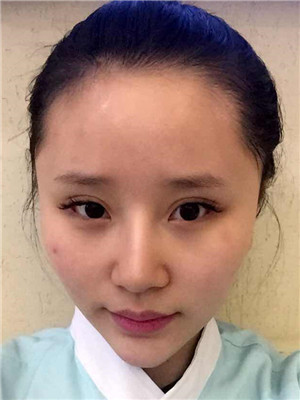 開了眼角之后，眼睛變得很勾人
