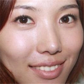武漢希思特做了埋線法雙眼皮、開內(nèi)眼角和鼻尖移植軟骨整形手術(shù)~