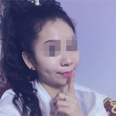 玻尿酸填充淚溝恢復過程和前后對比果圖片分享~