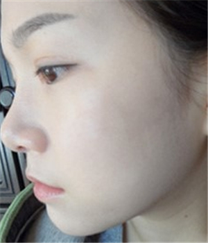 元旦做的光子嫩膚，分享恢復(fù)過程和前后對比果照片哦~