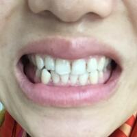 上海牙齒矯正過程分享，牙齒正畸8900元