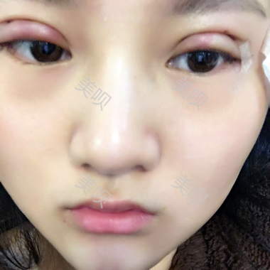 一個(gè)月時(shí)間的切開(kāi)雙眼皮消腫過(guò)程圖分享
