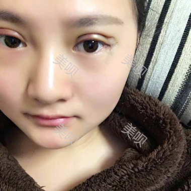 一個(gè)月時(shí)間的切開(kāi)雙眼皮消腫過(guò)程圖分享