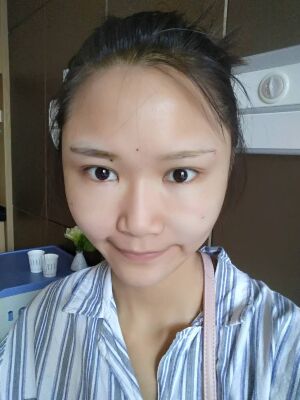 自體脂肪面部填充后恢復(fù)，成活率還蠻高的