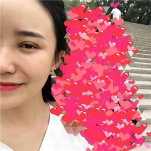 北京美萊做了雙眼皮手術(shù)，分享前后對(duì)比果圖片~