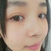臉上激光去痣日志分享，一共去痣2次