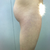 大腿抽脂瘦大腿恢復全過程我也有纖細的美腿了