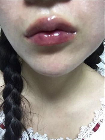 我做了玻尿酸豐唇和玻尿酸豐下巴 果還不錯哦