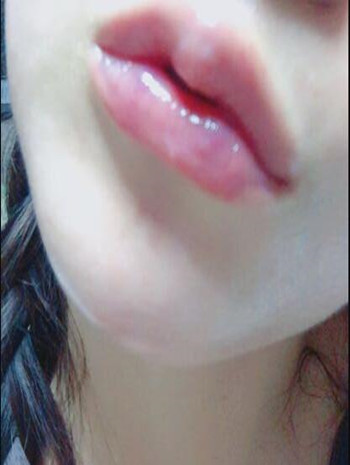 我做了玻尿酸豐唇和玻尿酸豐下巴 果還不錯哦