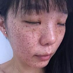激光祛斑——雀斑后臉上終于白凈了