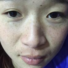 在南京光爾美醫(yī)療美容醫(yī)院做的激光祛斑緩解分享