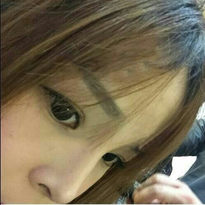 玻尿酸注射隆鼻三個月了，分享術(shù)后恢復(fù)照片哇~
