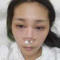 做鼻部綜合整形真是一件正確的決定，鼻子恢復過程分享