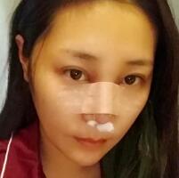 做鼻部綜合整形真是一件正確的決定，鼻子恢復過程分享