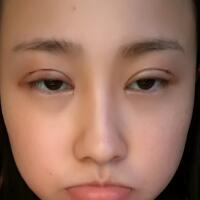 割雙眼皮恢復(fù)過(guò)程分享，整形價(jià)格3800元