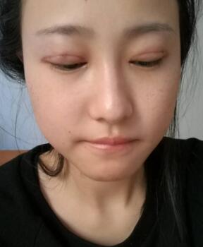 割雙眼皮整形恢復過程分享
