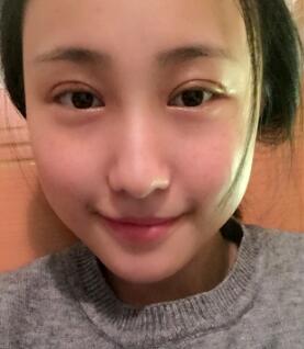 雙眼皮恢復的很好
