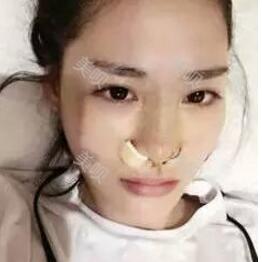 杭州廣仁做的硅膠假體隆鼻+鼻翼縮小我很滿(mǎn)意