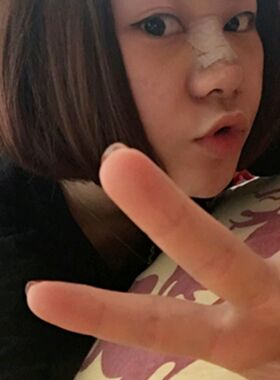 隆鼻整形前后對(duì)比照片 果是不是很好呀
