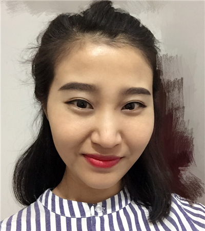 玻尿酸注射隆鼻前后對比果圖片分享，大同美神賈文醫(yī)生做的~