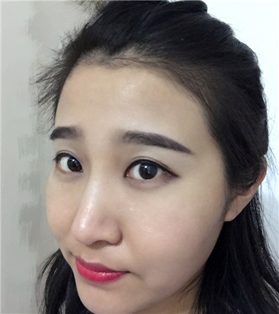 玻尿酸注射隆鼻前后對比果圖片分享，大同美神賈文醫(yī)生做的~