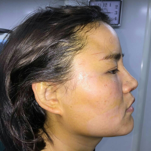 自體軟骨移植隆鼻恢復(fù)過程和前后對(duì)比果照片分享，張海明做的~
