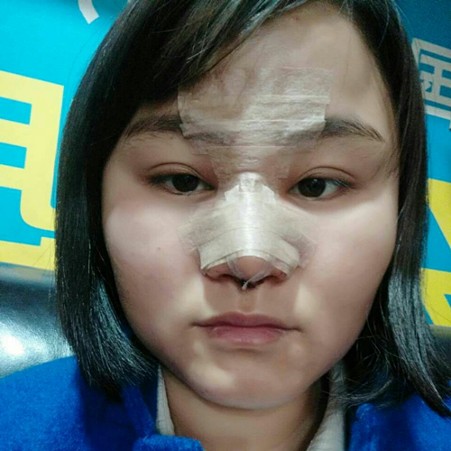 自體軟骨移植隆鼻恢復(fù)過程和前后對(duì)比果照片分享，張海明做的~
