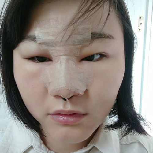 自體軟骨移植隆鼻恢復(fù)過程和前后對(duì)比果照片分享，張海明做的~