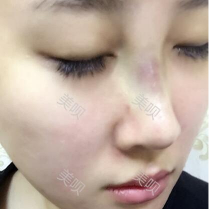 膨體隆鼻+墊鼻尖一個月時間的恢復(fù)過程