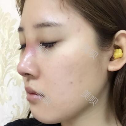 膨體隆鼻+墊鼻尖一個月時間的恢復(fù)過程