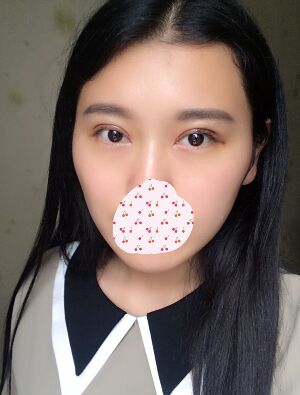 雙眼皮失敗修復手術(shù)恢復超自然，看起來一點都不假