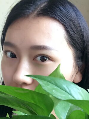 雙眼皮失敗修復手術(shù)恢復超自然，看起來一點都不假