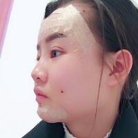 自體脂肪面部填充恢復(fù)過(guò)程分享，填充價(jià)格12000元