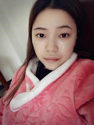 去年12月做的自體脂肪填充蘋果肌，大家來看看果怎么樣?
