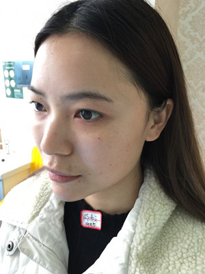 去年12月做的自體脂肪填充蘋果肌，大家來看看果怎么樣?