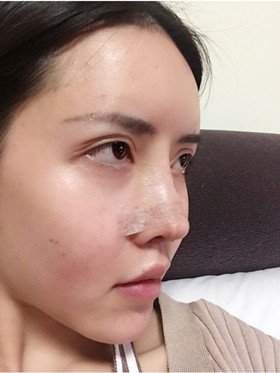 自體軟骨隆鼻+自體脂肪豐蘋果肌，成功逆襲成女神
