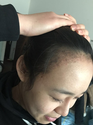 做了發(fā)際線種植手術(shù)，感覺還不錯!