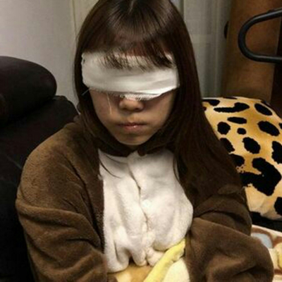 開內(nèi)眼角+切開割雙眼皮兩個(gè)月了，分享術(shù)后恢復(fù)過程照片~