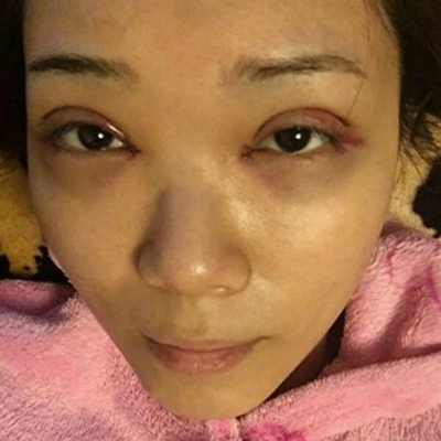 開內(nèi)眼角+切開割雙眼皮兩個(gè)月了，分享術(shù)后恢復(fù)過程照片~