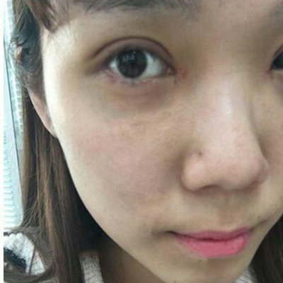 開內(nèi)眼角+切開割雙眼皮兩個(gè)月了，分享術(shù)后恢復(fù)過程照片~