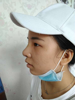 廣州廣美做的假體隆鼻，給大家分享一下手術(shù)前后過(guò)程以及對(duì)比照片