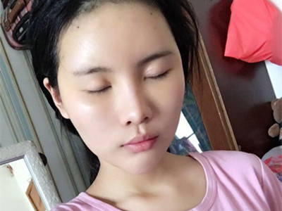自體脂肪填充全臉，前后對(duì)比一下果棒棒噠!