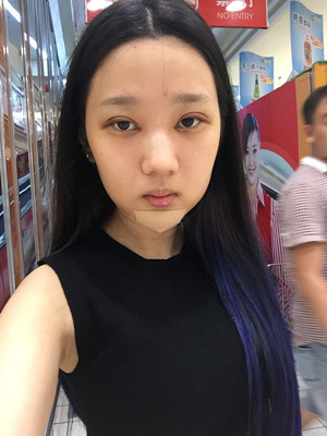 切開雙眼皮+假體隆下巴，我不再是典型的路人甲