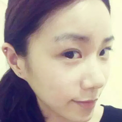 隆鼻整形+雙眼皮手術(shù)兩個月了，分享恢復前后對比果照片~